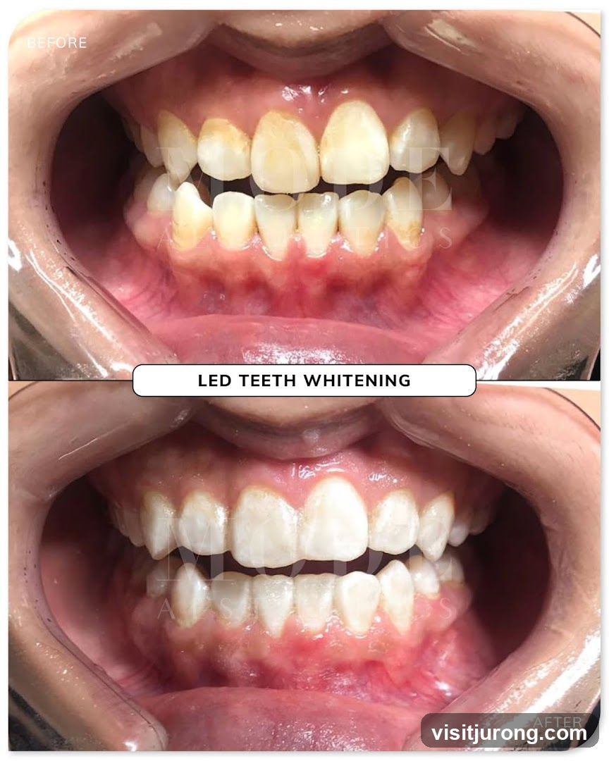 LED Teeth Whitening Before and After