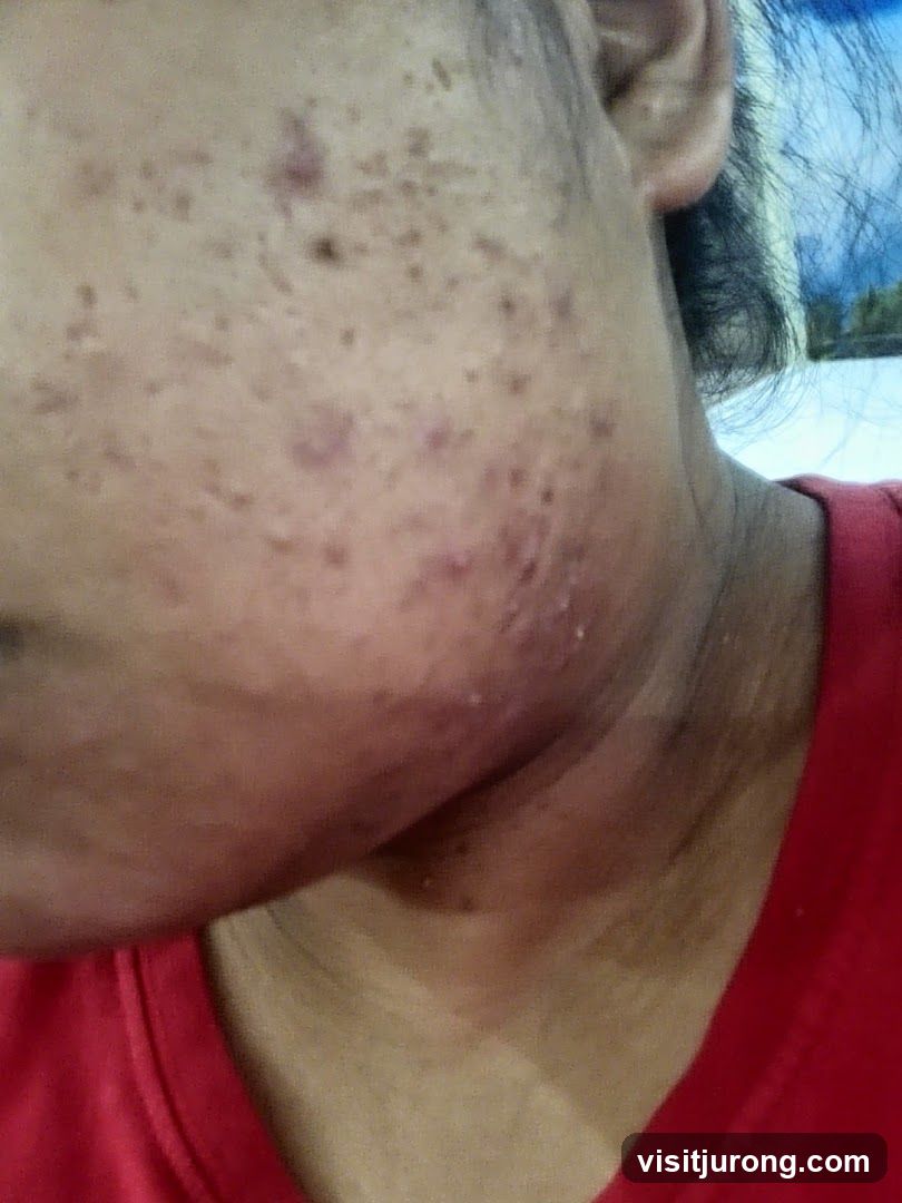 Acne on Face