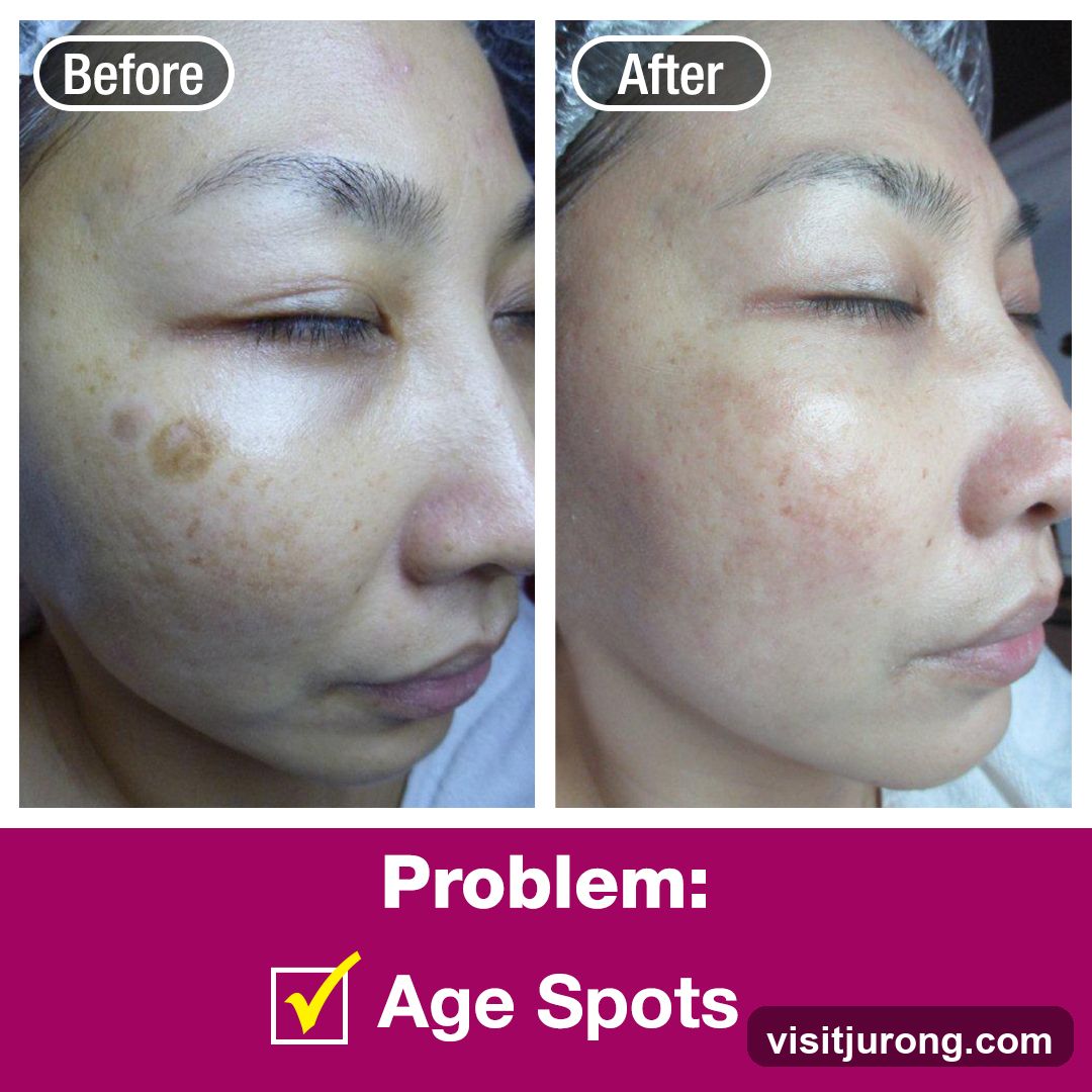 Before and After Age Spots