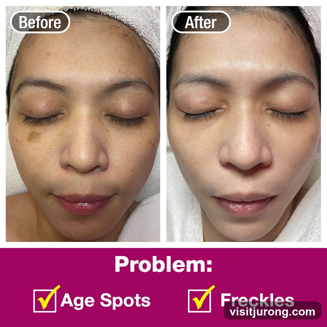 Before and After Skin Treatment