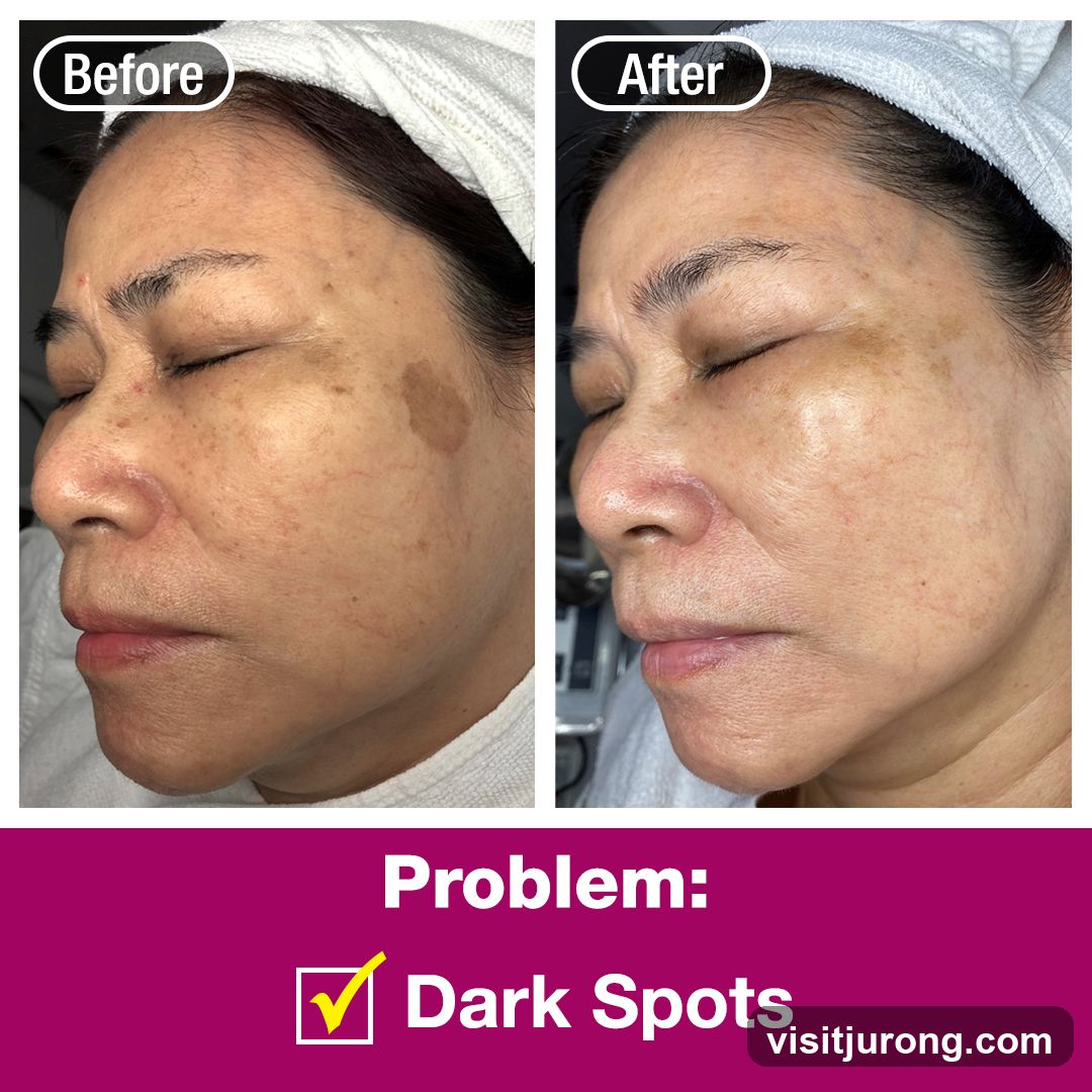 Before and After Dark Spot Treatment