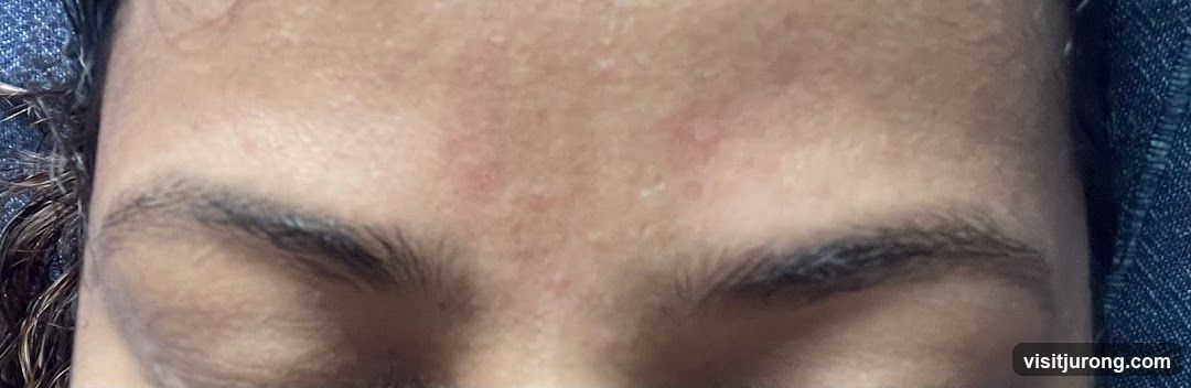 Forehead and Eyebrows
