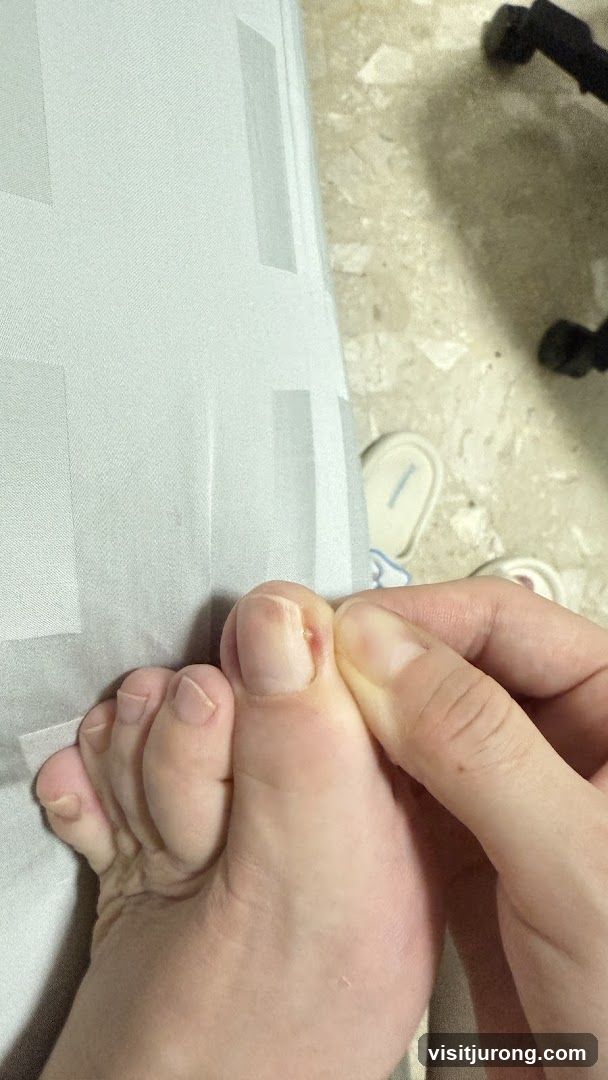 Close-up of a foot with a visible ingrown toenail