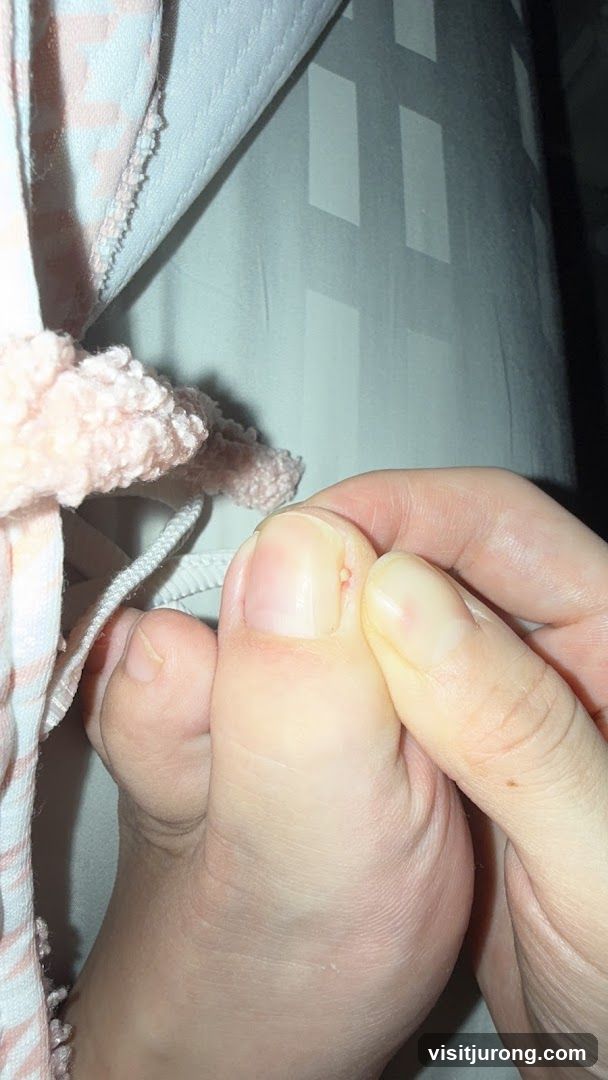 Close-up of a toe with a small blister
