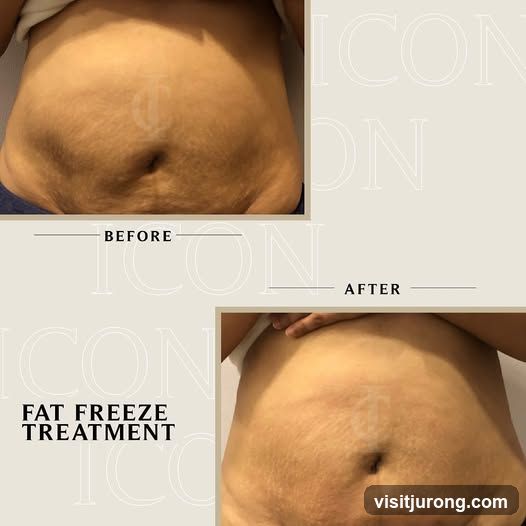 Fat Freeze Treatment Before and After