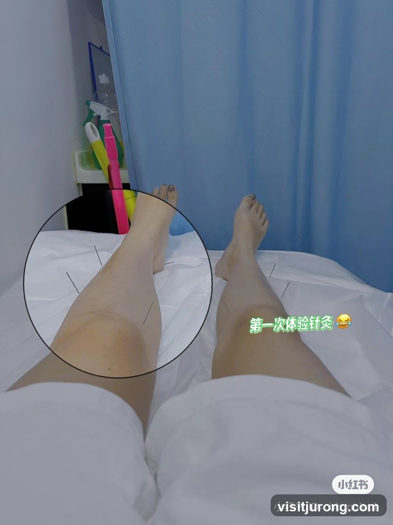 Acupuncture Treatment