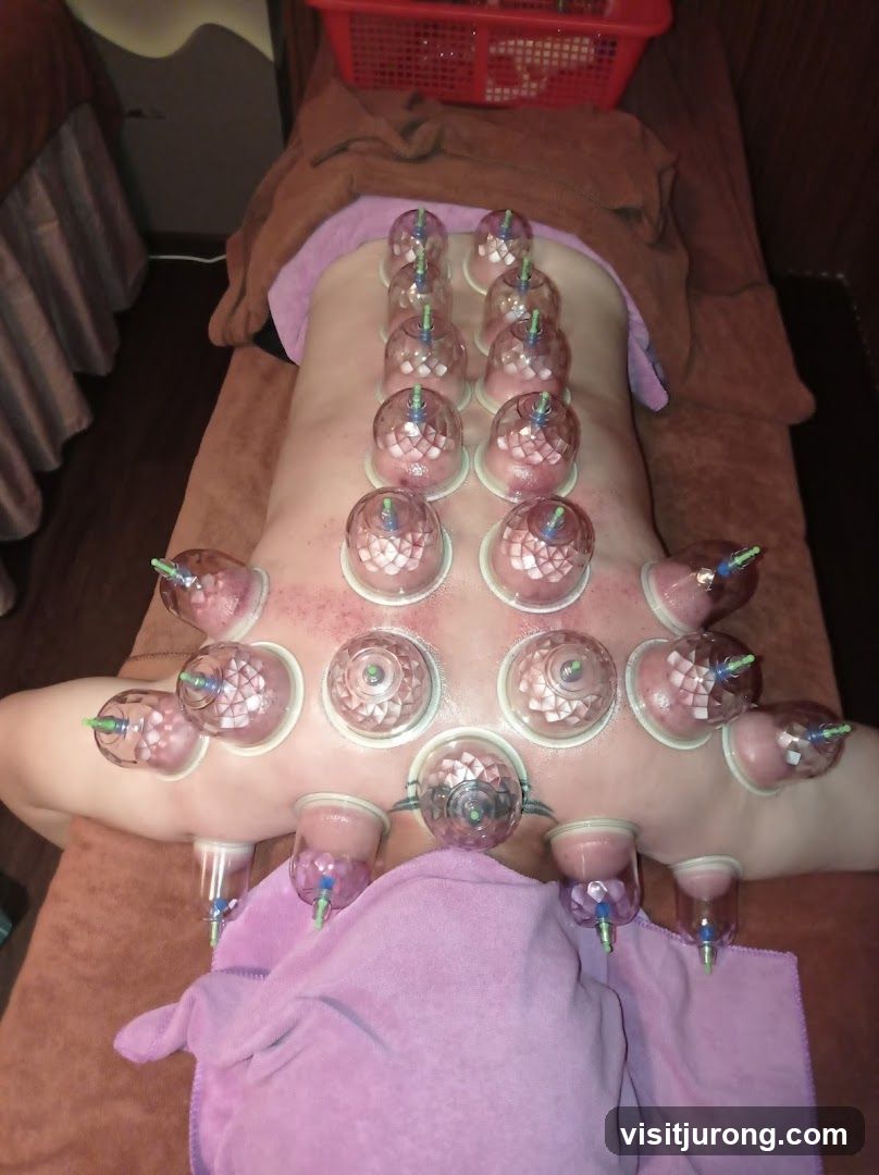 Cupping Therapy
