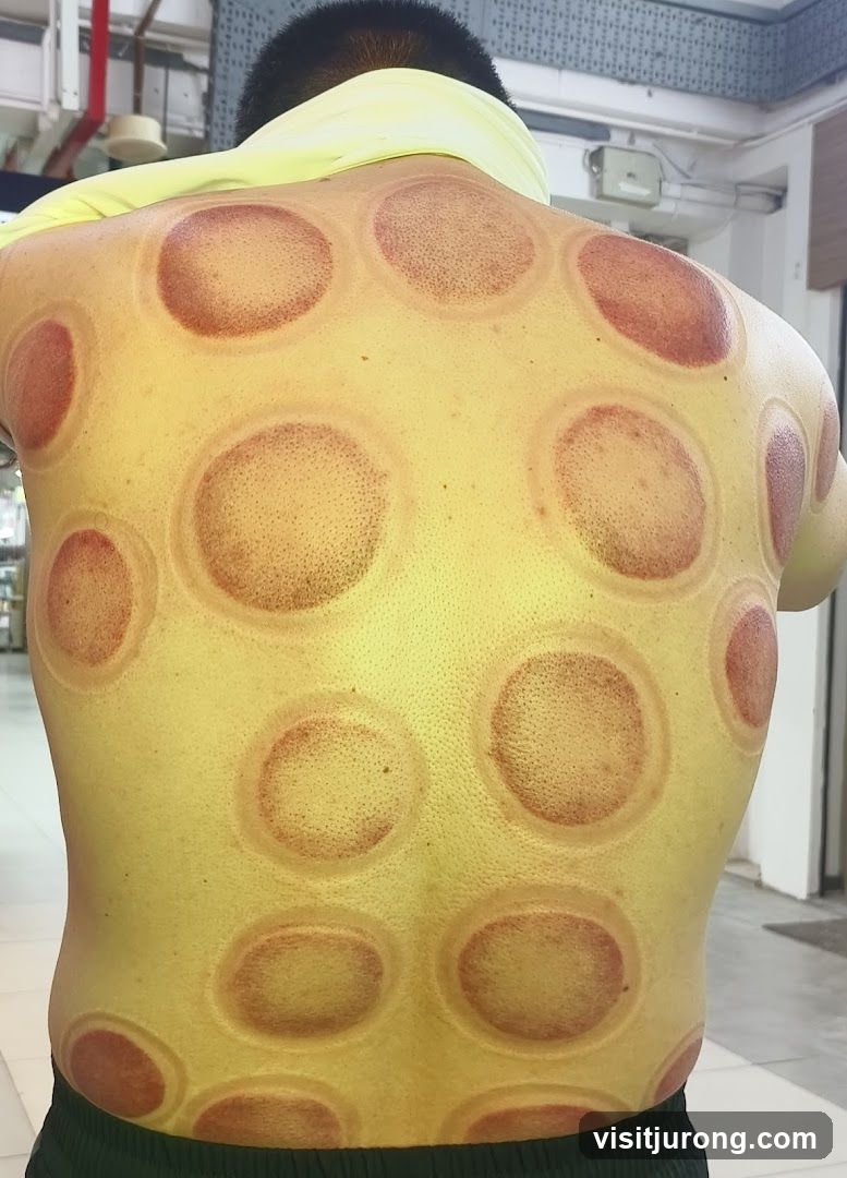 Cupping Therapy Marks on Back